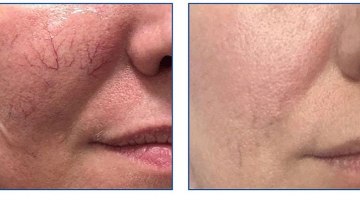 //img1.wsimg.com/isteam/ip/75bf478f-2149-4a71-a2e1-04cc89f7112e/Red-Vein-Removal-1.jpg/:/rs=w:1300,h:800