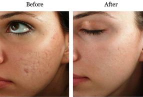 Microneedling acne scars