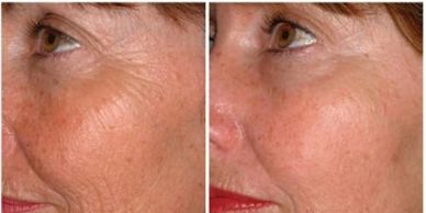Microneedling fine lines and wrinkles