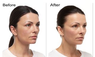 Cheek augmentation