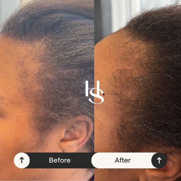 Hair Restoration Program