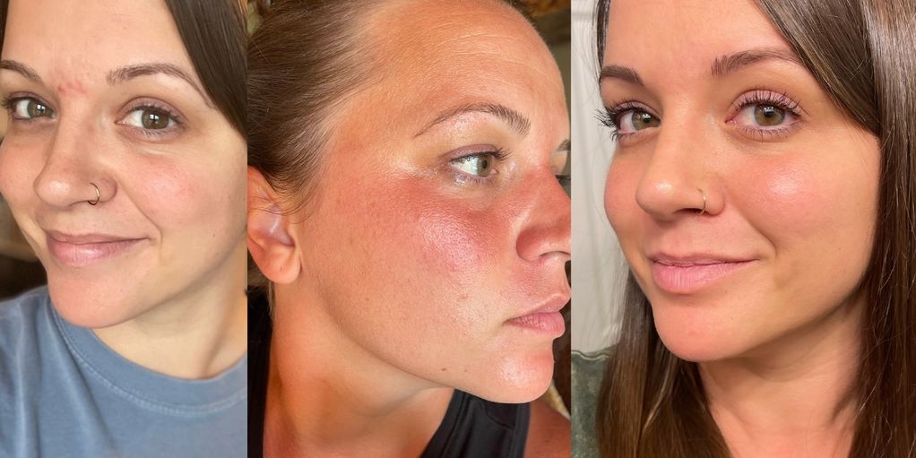 These are my results from using the Revival oil, the Healing & Anti Aging salve and Tallow cream.