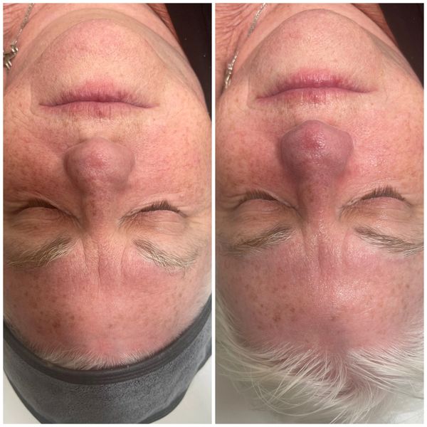 Side-by-side images showing a forehead before and after a skin treatment.