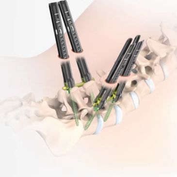 3D medical illustration of spinal fusion surgery with screws and rods.