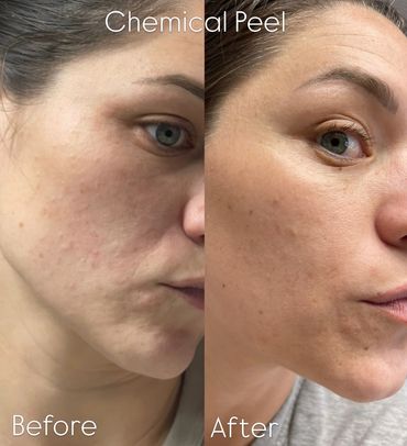 Chemical peel before and after. She was experiencing under the skin congestion and inflammation. 