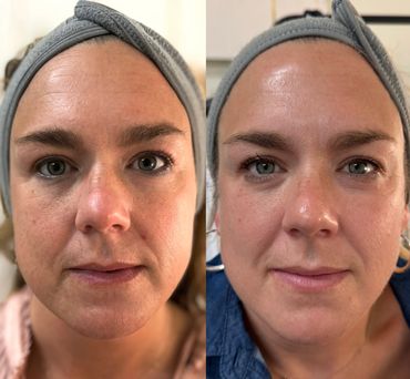 skin rejuvination treatment columbus ms skin deep esthetics