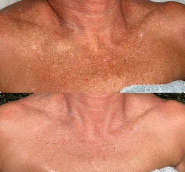 Microneedeling tretment that treated sun damage, fine line and wrinkles, acne scars, pigmentation. 
