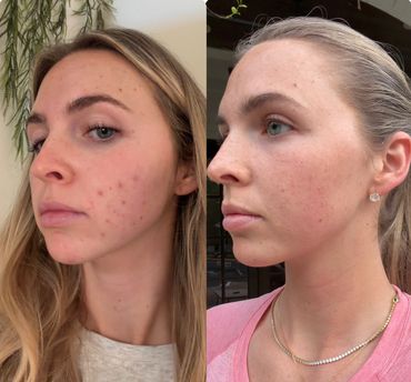 five month acne transformation acheived through consistent in studio treatments and homecare.