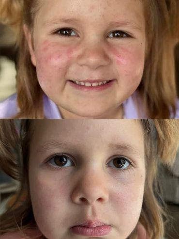 Before and after skin healing with SIV serum helping redness and irritation from chemo treatments