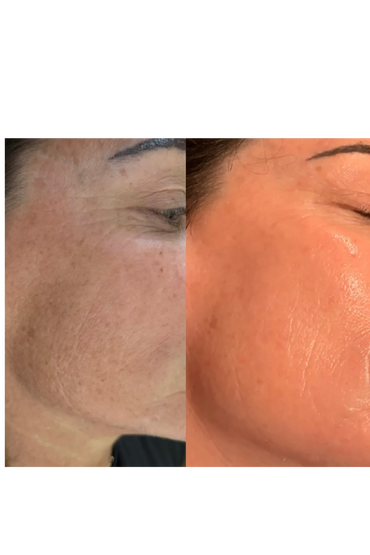 Procell micro channeling before and after, sun damage, age spots and fine lines.
