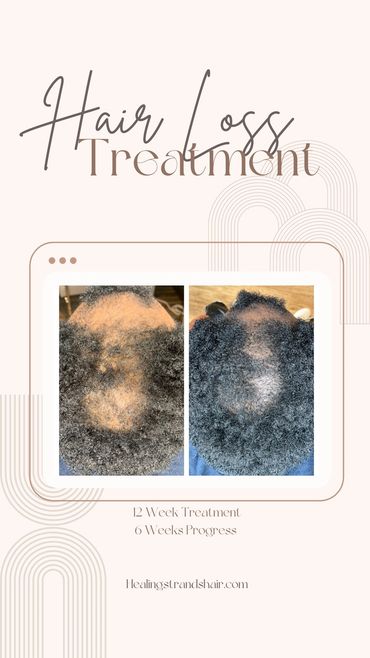 Men want hair too!. No Rogaine. No Minoxidil. No injections. 