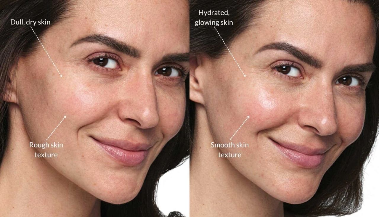 glutathione beauty booster naples Skinvive: Injectable Skin Booster