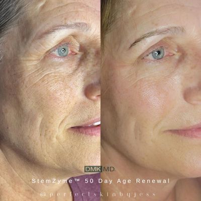 A before and after feafuring a woman with aging, hyperpigmented skin that has significantly improved