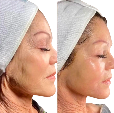 Before and after image depicting dermal age regression after dmkmd remodeling procedure.