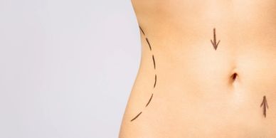 non-surgical tummy tuck Christmas offer London.
