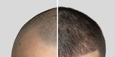 Male patient undergoing FUE hair transplant procedure for hair restoration at Royal Derma Clinic.