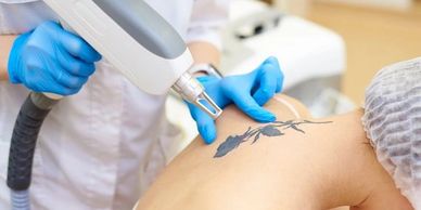 Laser tattoo removal in progress to fade unwanted ink safely at Royal Derma Clinic.