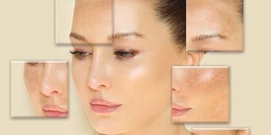 Close-up of a woman with dark facial pigmentation and melasma patches treated at Royal Derma Clinic.