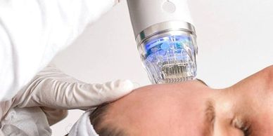 Patient undergoing MNRF treatment for skin tightening and acne scar reduction at Royal Derma Clinic