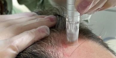 Close-up of Dermapen microneedling treatment for hair growth stimulation  at Royal Derma Clinic.