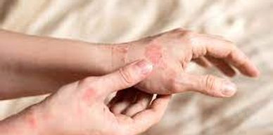 irritated skin with red rash, bumps, with symptoms of a skin allergy treated at Royal Derma Clinic.