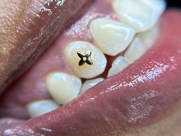 Various Tooth gem shapes, colors, + sizes including 18k gold charms for self-application