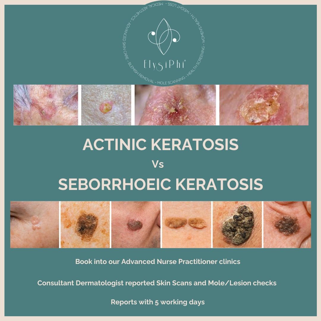 Actinic Keratosis Vs Seborrhoeic Keratosis