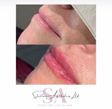 natural lip enhancement using filler 