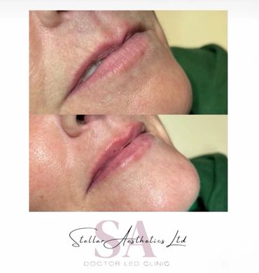 natural lip enhancement using filler 