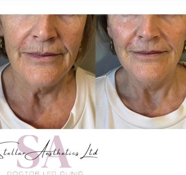 cheek volume dermal filler 