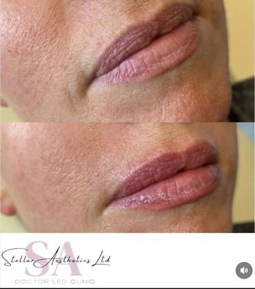 natural lip enhancement using filler 