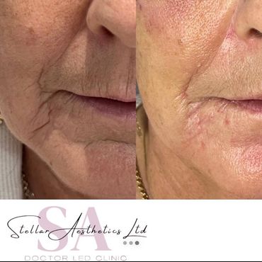 peri oral rejuvenation using filler to chin areas and marionette lines 