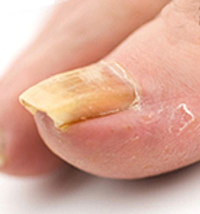 Ingrowing toe nails info