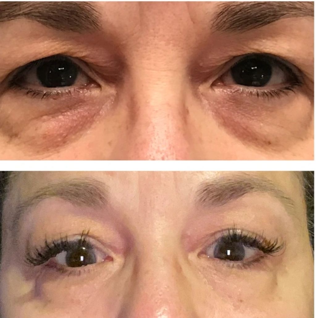 No injections !  Connective tissue manipulation and skin treatments .