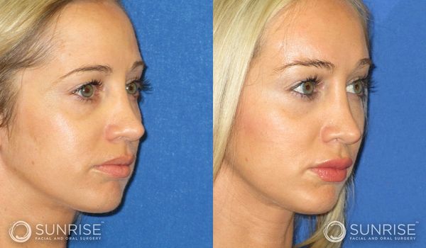 Before and after facial surgery showing improved nose and lip appearance.