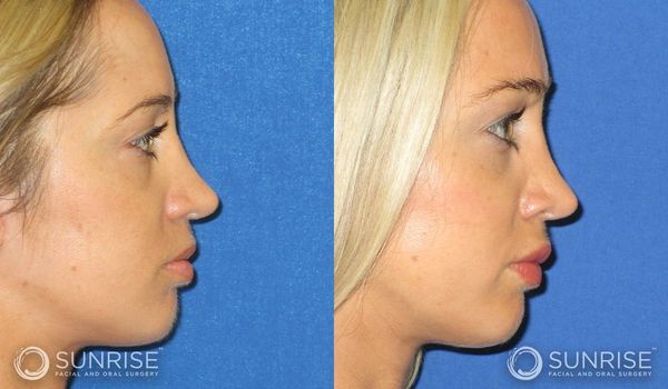 Side-by-side before and after profile photos of a woman showing facial changes.