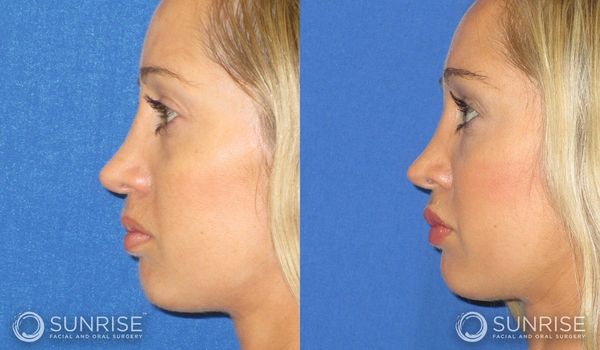 Side-by-side before and after profile photos of a woman post-rhinoplasty.