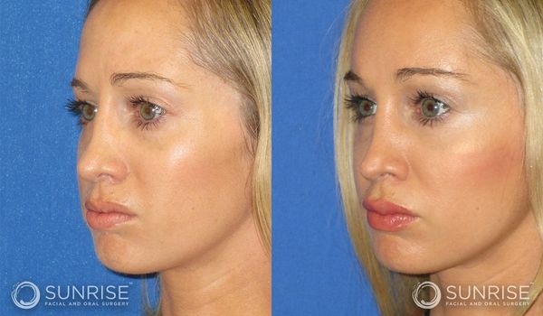 Before and after facial surgery showing improved chin profile.
