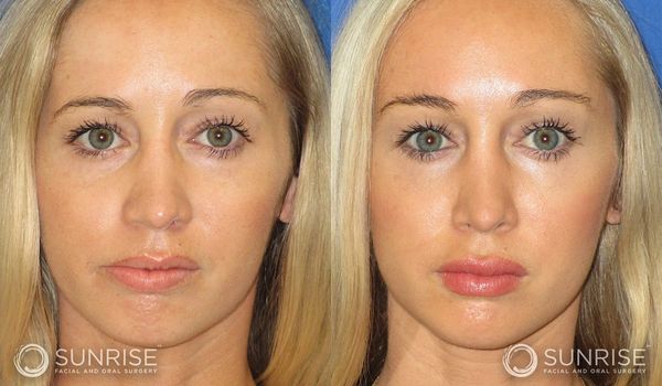 Before and after lip augmentation surgery on a woman.