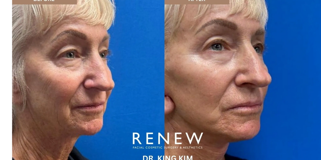 Lisa's Mini Sunrise Facelift