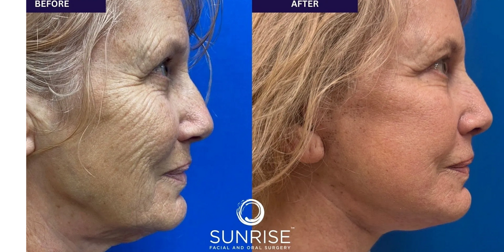 Donna's Mini Facelift