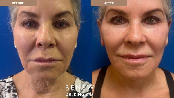 Before and after facial cosmetic treatment showing skin tightening and rejuvenation.