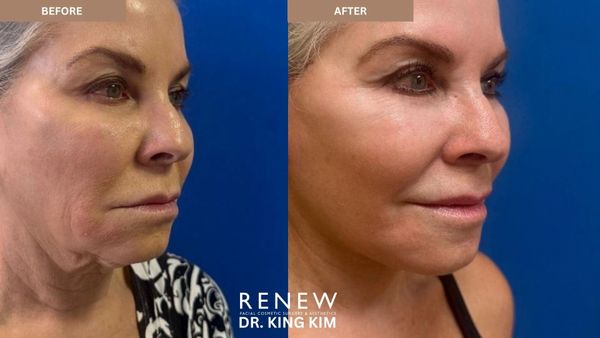 Before and after facial cosmetic treatment showing smoother skin and reduced wrinkles.