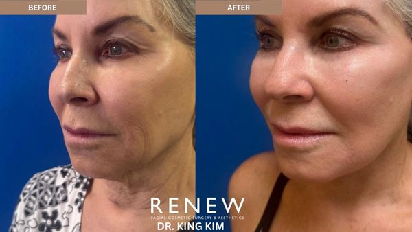 Before and after facial cosmetic surgery showing smoother skin and reduced wrinkles.