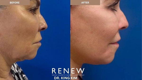 Side-by-side before and after images of a facial cosmetic procedure showing improved jawline.