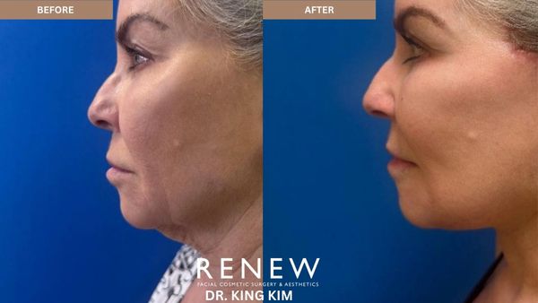 Before and after facial cosmetic surgery showing a more defined jawline and smoother skin.