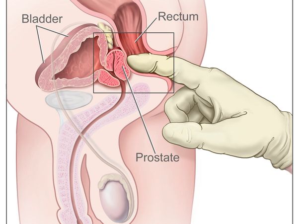 Docteur Caullery. Urologue a Frejus Saint raphael. Cancer de la prostate.