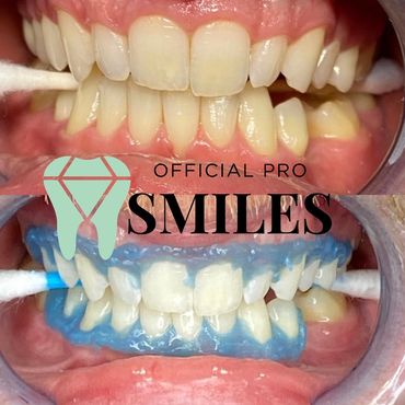 Teeth whitening phoenix, teeth whitening chandler, teeth whitening Scottsdale, teeth whitening 