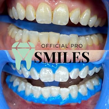 Teeth whitening phoenix, teeth whitening chandler, teeth whitening Scottsdale, teeth whitening 