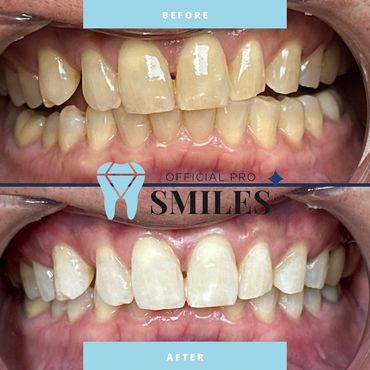 Teeth Whitening Services by Official Pro Smiles Mesa Arizona
